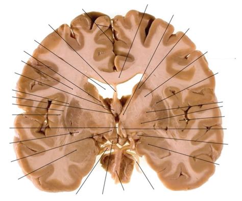 label  mid coronal slice diagram quizlet