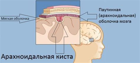 Киста головного мозга арахноидальная, ретроцеребеллярная, киста ...