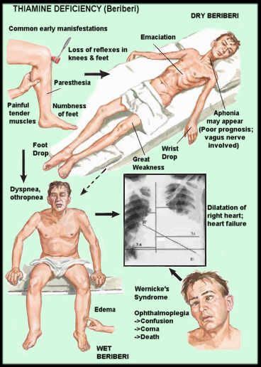 Wernicke- Korsakoff Syndrome: Causes, symptoms & Treatments | Global Treatment Services Pvt. Ltd.