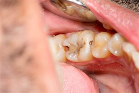 mga gamot  procedure  sa bulok na ngipin anu ano nga ba ito