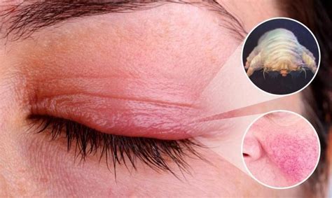 Ocular Demodicosis Unveiled: Causes, Symptoms, and Treatment