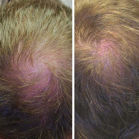 mesoterapia capilar oniderm clinica de unas