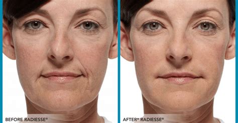 Radiesse Antes E Depois Rosto - Radiesse Antes E Depois Das Linhas Do Sorriso Radiesse: Resultados E