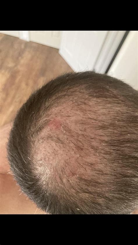 how long to leave minoxidil on scalp