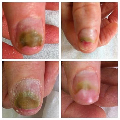 how to get rid of greenies on nails