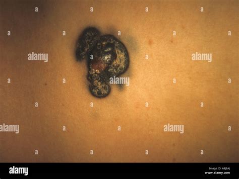 malignant melanoma nodular  res stock photography  images alamy