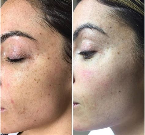 Before & After — Simply Skin Laser Medispa