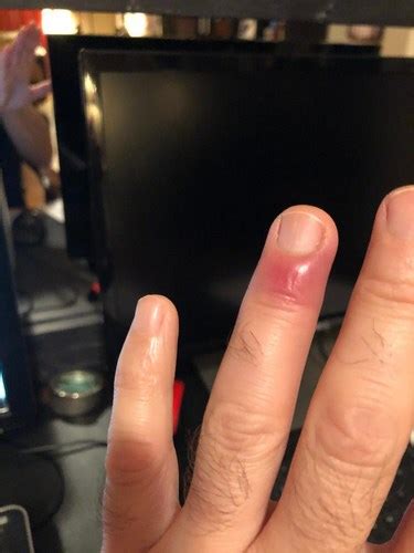 how to drain pus from finger at home
