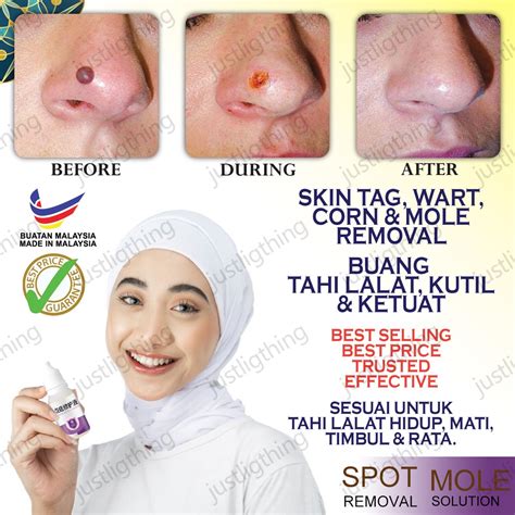 warts removal ointment wart remover original cream effectively remover