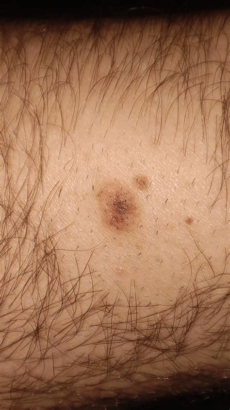 Worried about lump on mole : r/Melanoma