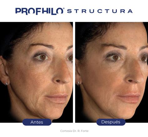profhilo  bioestimuladores