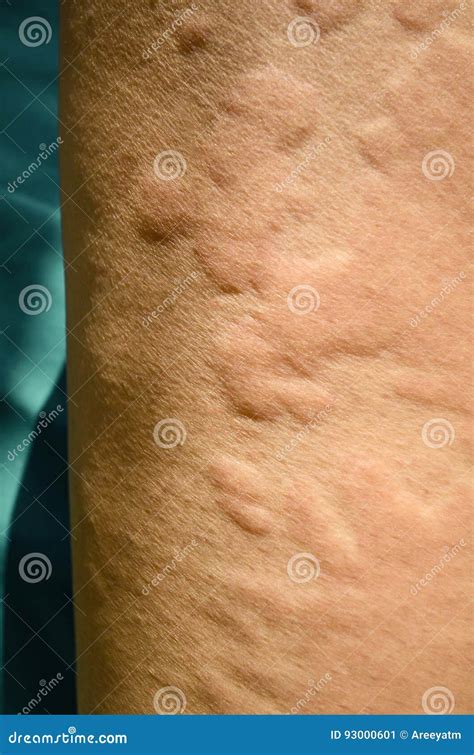 Itchy Skin From Allergic Reaction at Mark Cortese blog