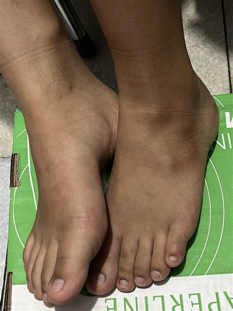 peeling manfaat efek samping heystetik