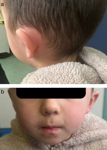 paediatric ear nose  throat ent emergencies