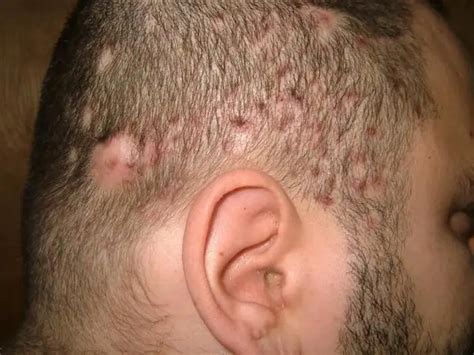 Folliculitis of the scalp: causes, symptoms, treatment | Diseases and ...
