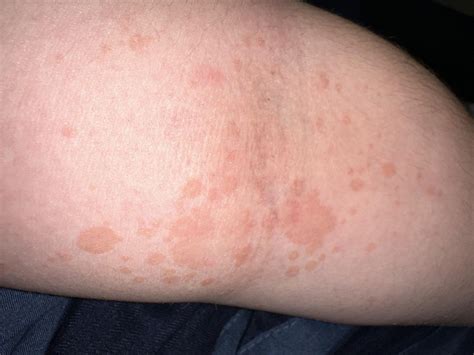 Rash : r/HIV