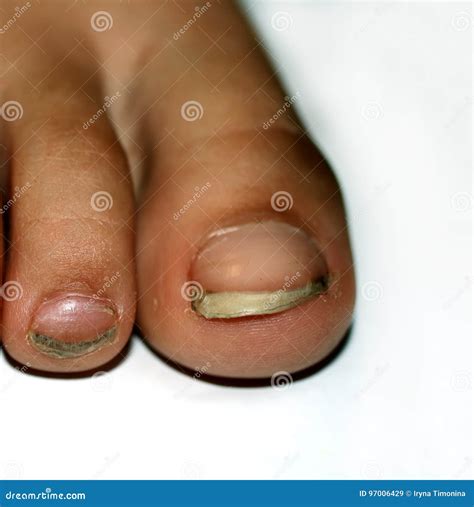 Ingrown Toenails On A Woman`s Foot, Isolated On White Background, Pain