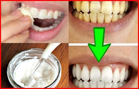 Bicarbonato Para Os Dentes - 10 maneiras de usar o bicarbonato de sódio para clarear os dentes ...