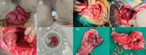 Frontiers | Sudden rupture of recurrent rectal prolapse complicated by