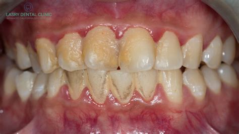 plaque pictures  teeth