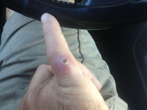 Mrsa On Finger
