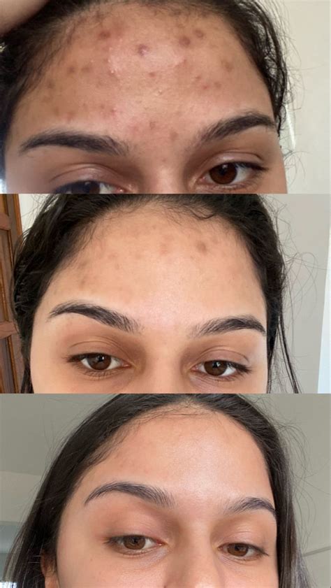 Vitacid Gel Antes E Depois