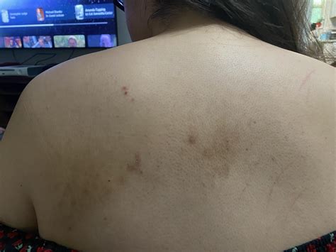 What are these itchy discolored spots on my back? : r/30PlusSkinCare