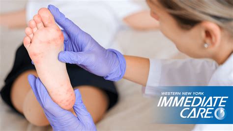 Hand, Foot, and Mouth | Doctor's Orders | WNY Immediate Care