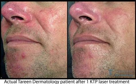 ktp laser minneapolis mn tareen dermatology tareen dermatology