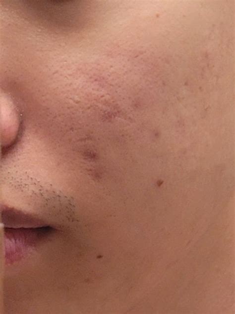 dark spots  acne rskincareaddiction