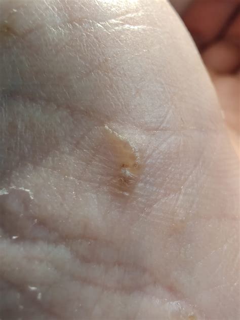 Does this look like scabies? : r/scabies