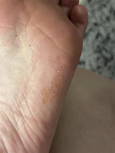 Possible mosaic wart? : r/Warts