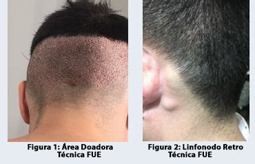 Dutasterida Cabelo Antes E Depois - Mesoterapia com Dutasterida no tratamento da Alopecia Androgenética