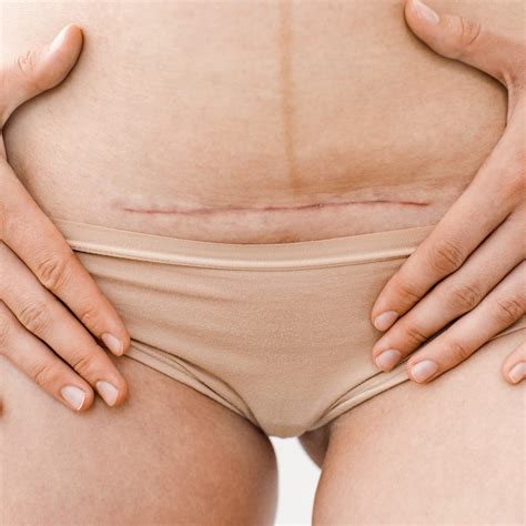 C-section Scar Therapy | The Osteoperformance Clinic