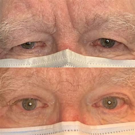 Blepharoplasty Panama City | Eyelid Surgery Panama City Beach