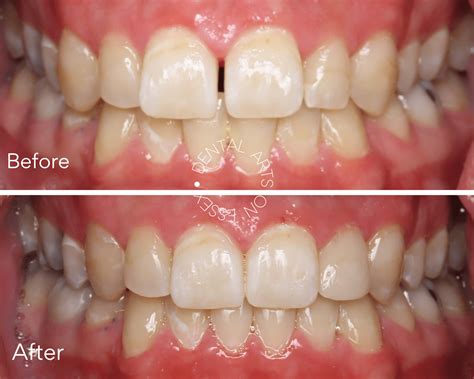 Before And After - Dental Arts on Essex