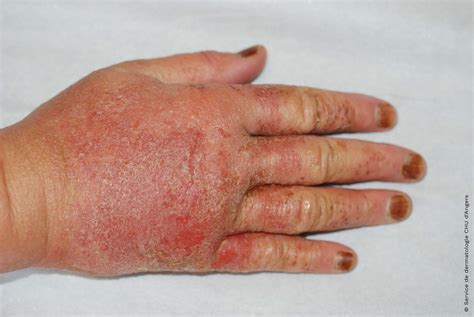 Eczema On Back Of Hands