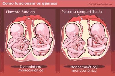 Gêmeos De Placenta Diferente - Tipos de gêmeos e trigêmeos | Os Trigêmeos da Michele