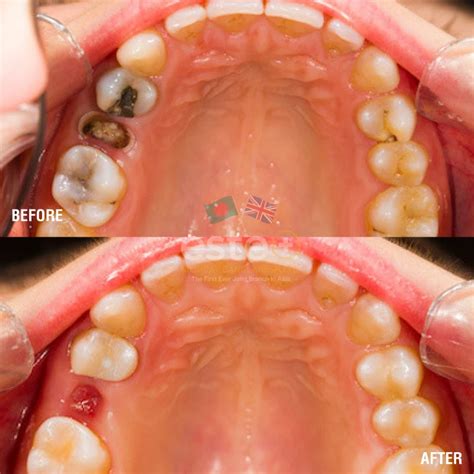 tooth extraction este medical bangladesh  uks leading skin