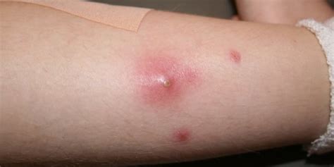 5 Penyebab Bisul Pada Bayi dan Cara Mengatasinya | merdeka.com