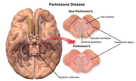 Parkinson É Hereditário - Genética del Parkinson y sus causas | CEFEGEN