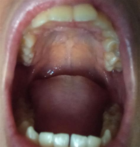 high  narrow palate rmewing