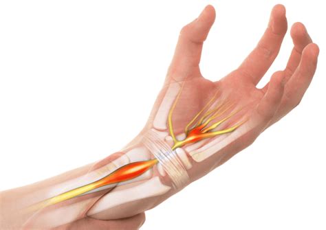 hand  wrist pain treatment  ireland  uk regenecare