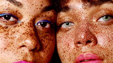 hyperpigmentation