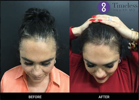 PRP Hair Restoration - West Covina, CA: Timeless Health MD ...