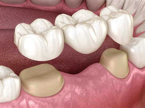 Cosmetic Dentistry Procedures 3: How Do Dental Bridges Work