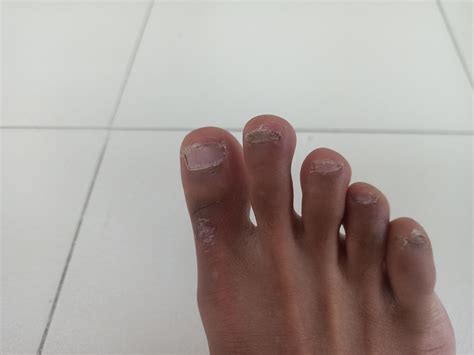 ugh. ugly. : r/Onychotillomania