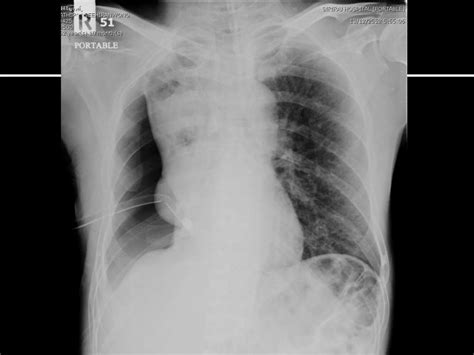 Medical pleurodesis