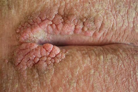 Papilloma on Skin: HPV Link, Appearance, and Removal