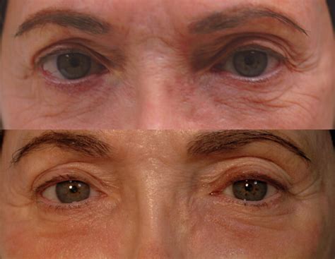 Remove Under Eye Wrinkles Laser Sale | centralcountiesservices.org